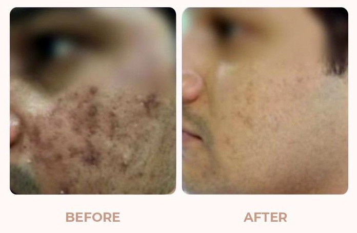 Acne-Before-After-01.jpg