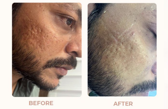 Acne-Scar-Results-Before-After-01.jpg