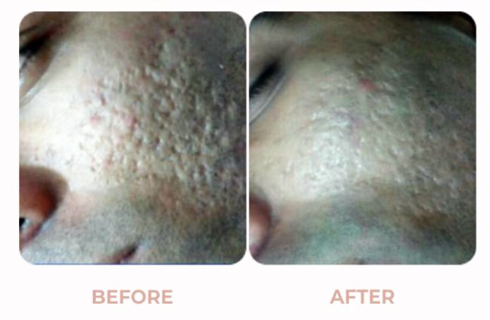 Acne-Scar-Results-Before-After-02.jpg