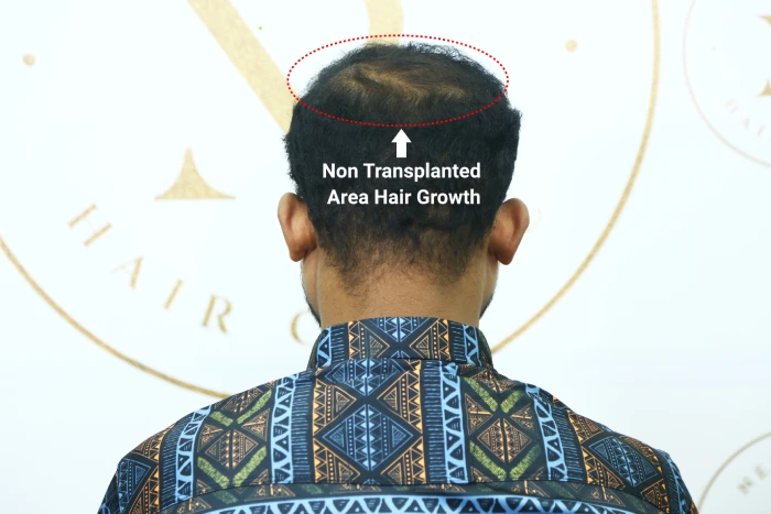 Afte 6 Months non transplanted area hair growth