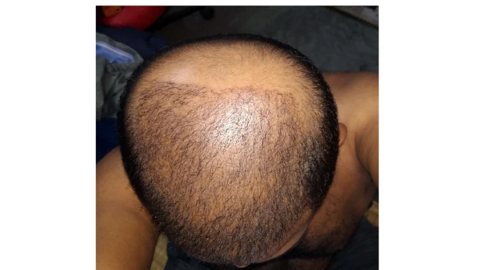 After 1 month