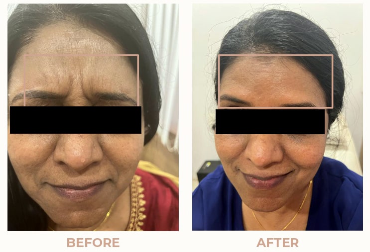 Anti-Aging-Result-04.jpg