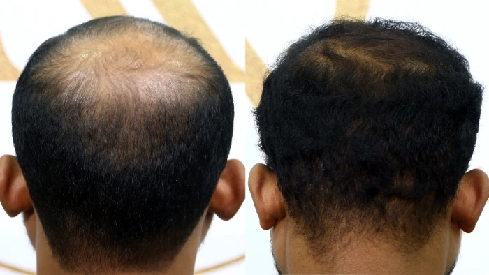 Before & After