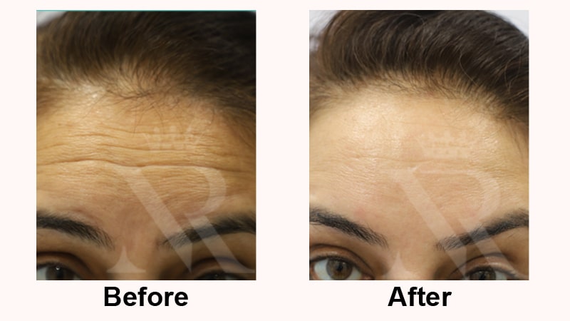 Botox-Result-01.jpg