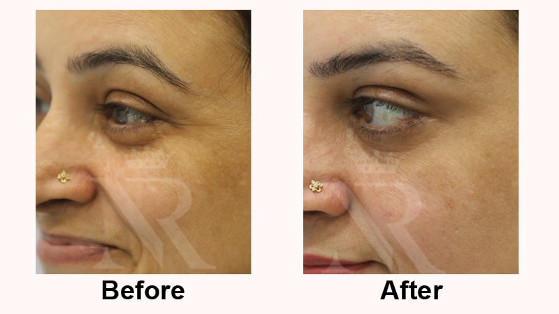 Botox-Result-02.jpg