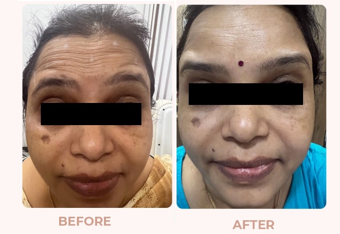 Botox-Result-03.jpg