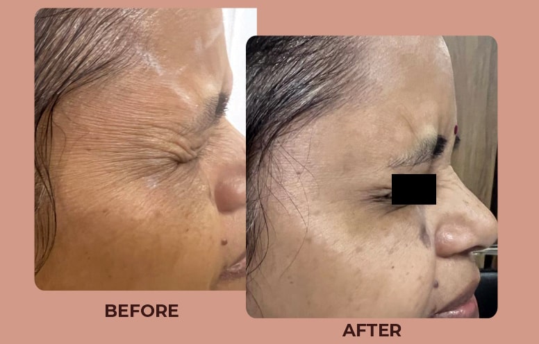 Botox-Result-04.jpg
