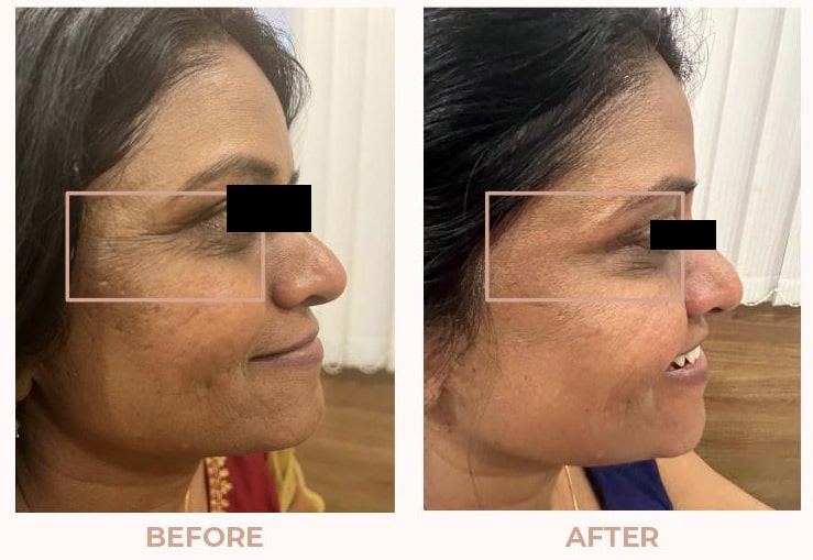 Botox-Result-05.jpeg
