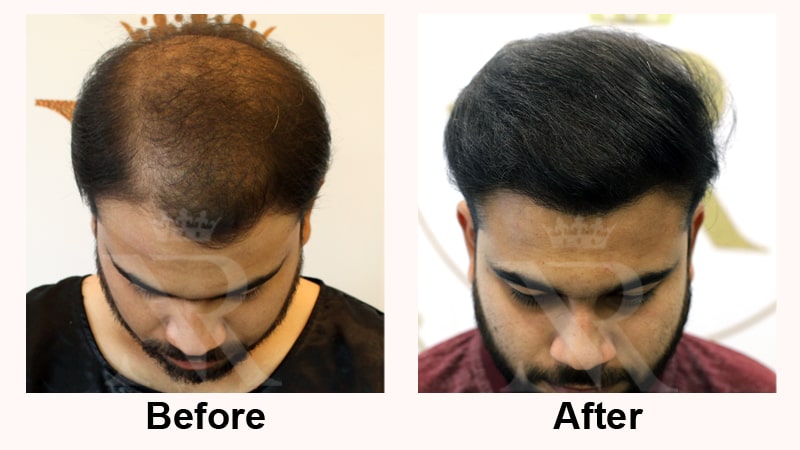 Hair-Transplant-Result-02.jpg