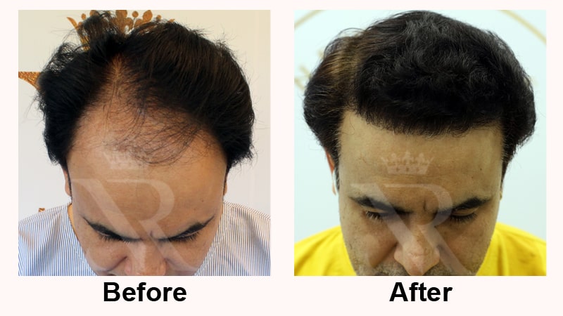 Hair-Transplant-Result-03.jpg