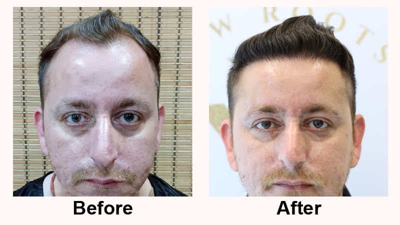 Hair-Transplant-Result-04.jpg