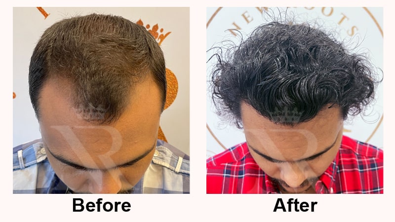 Hair-Transplant-Result-06.jpg