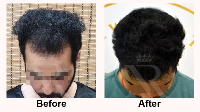 Hair-Transplant-Result-08.jpg