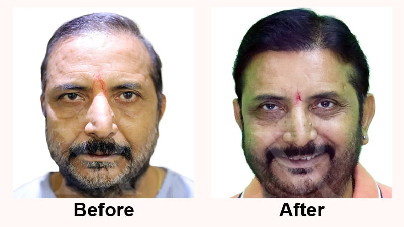 Hair-Transplant-Result-10.jpg