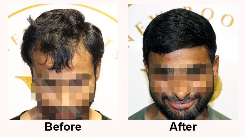 Hair-Transplant-Result-11.jpg
