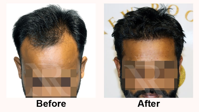 Hair-Transplant-Result-12.jpg