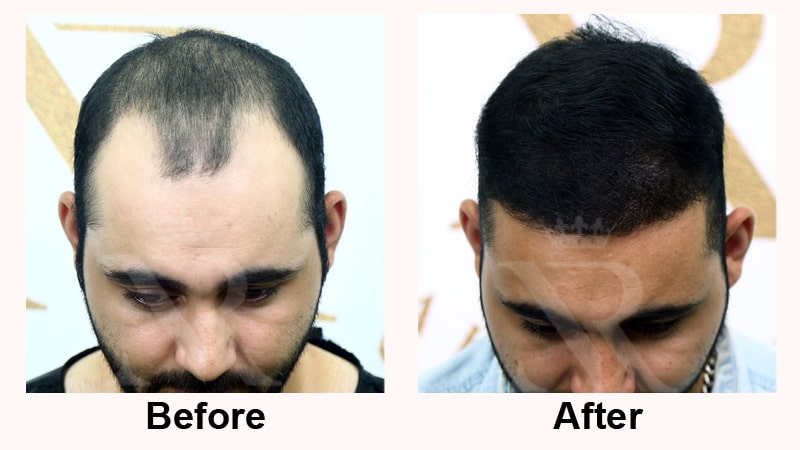 Hair-Transplant-Result-13.jpg
