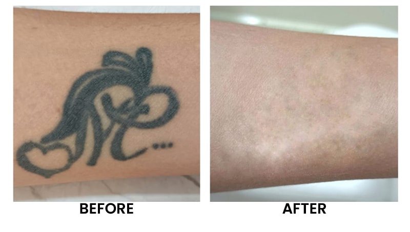 Laser-Tattoo-Removal-Before-After-01.jpg