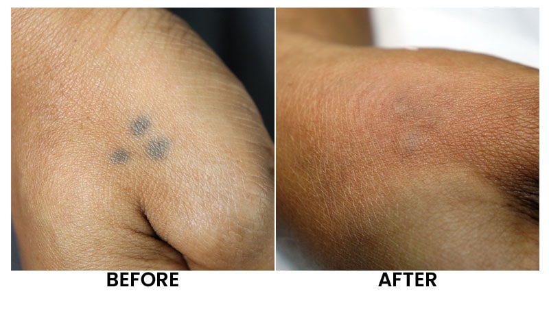 Laser-Tattoo-Removal-Before-After-02.jpg