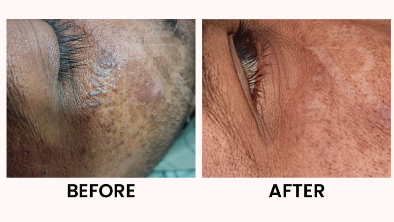Skin-Growth-result-04.jpg