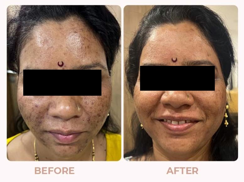 Skin-Pigmentation-Before-after-01.jpg