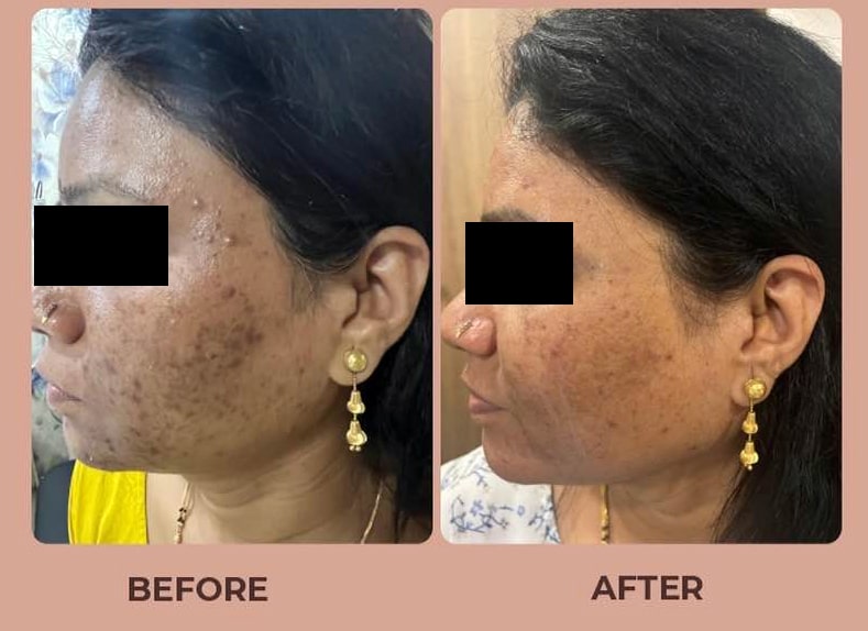 Skin-Pigmentation-Before-after-02.jpg