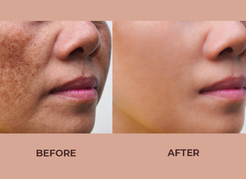 Skin-Pigmentation-Before-after-03.jpg