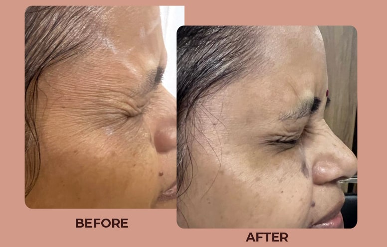 Skin-Rejunivation-Before-After-02.jpg