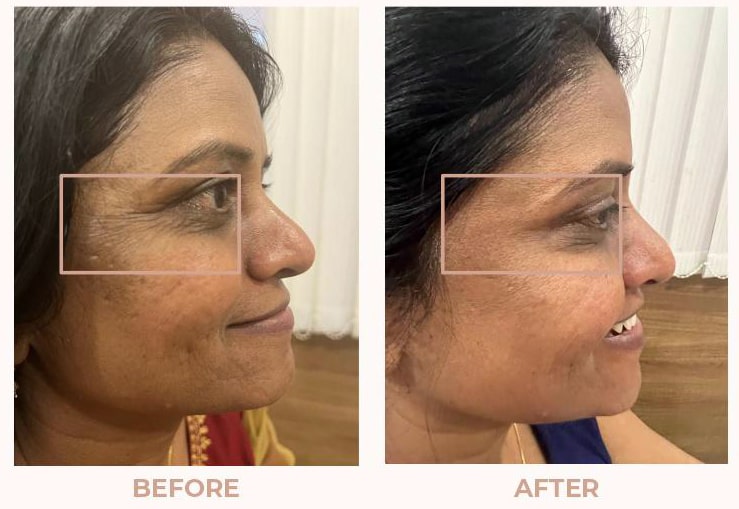 Skin-Rejunivation-Before-After-03.jpeg
