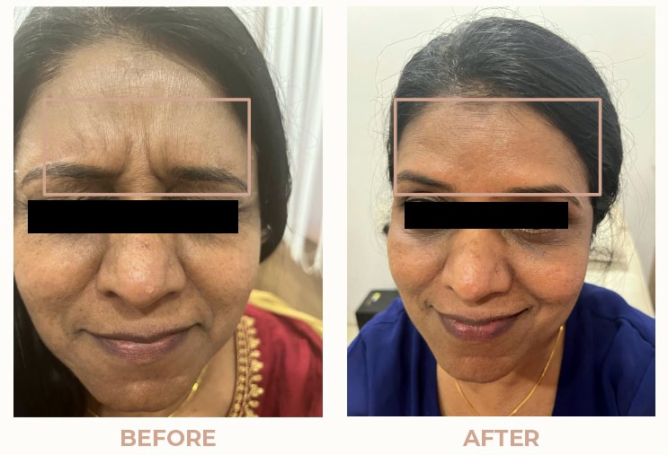 Skin-Rejunivation-Before-After-04.jpg