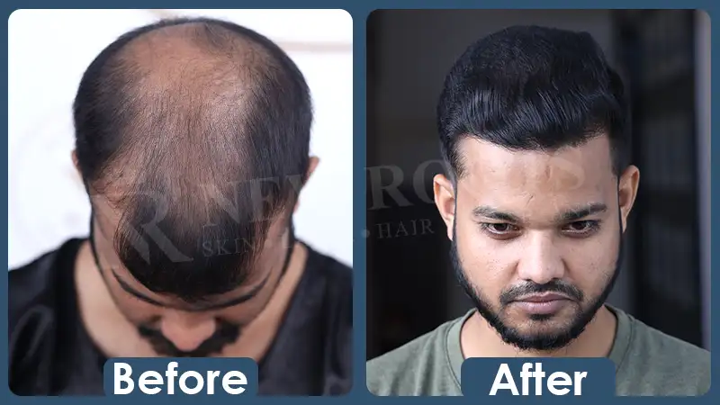 BSHT - Before After 1