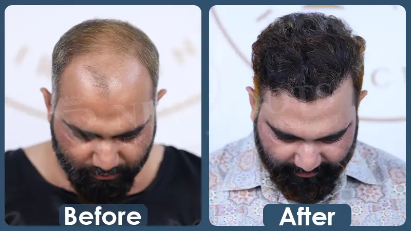 BSHT - Before After 2
