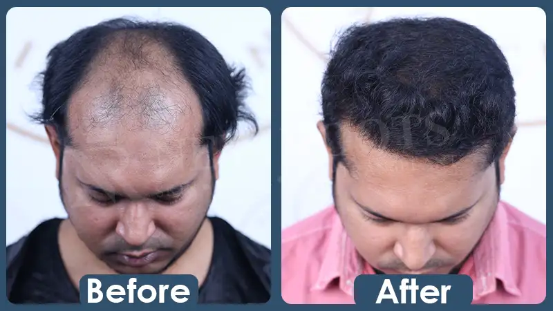 BSHT - Before After 3