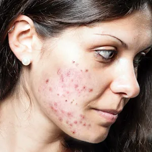 acne treatment dermatologist