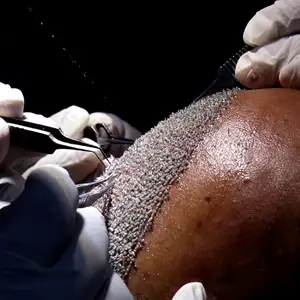 FUE hair transplant