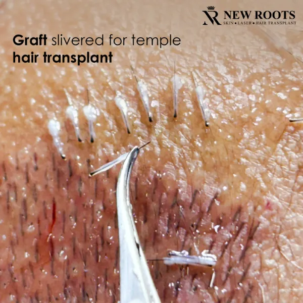 Graft Silvered