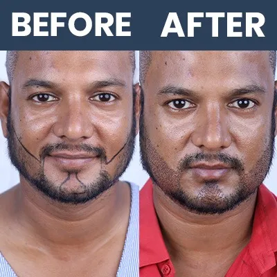 Beard Hair Transplant Result 05 - March 2025