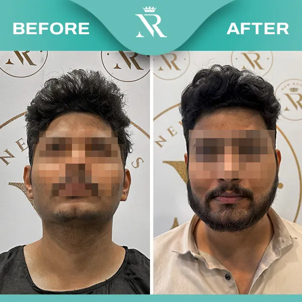 Before & After Bangladesh