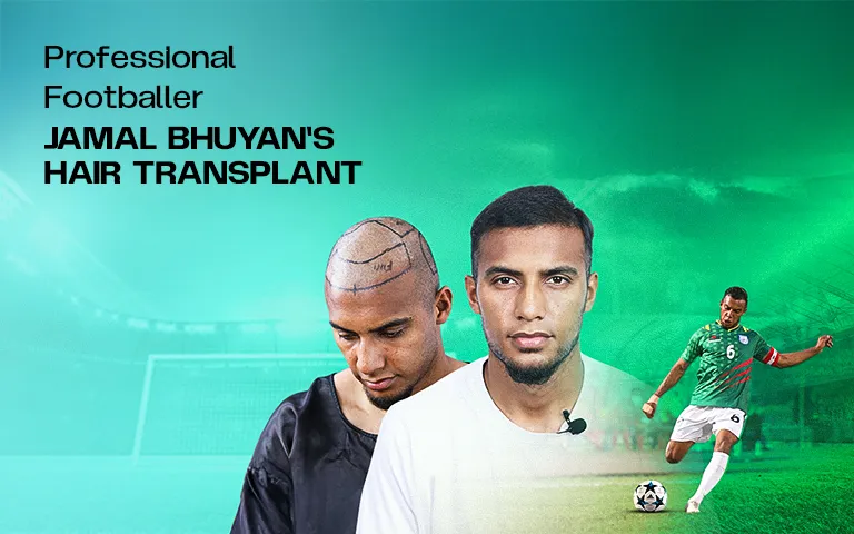 jamal bhuyan hair transplant