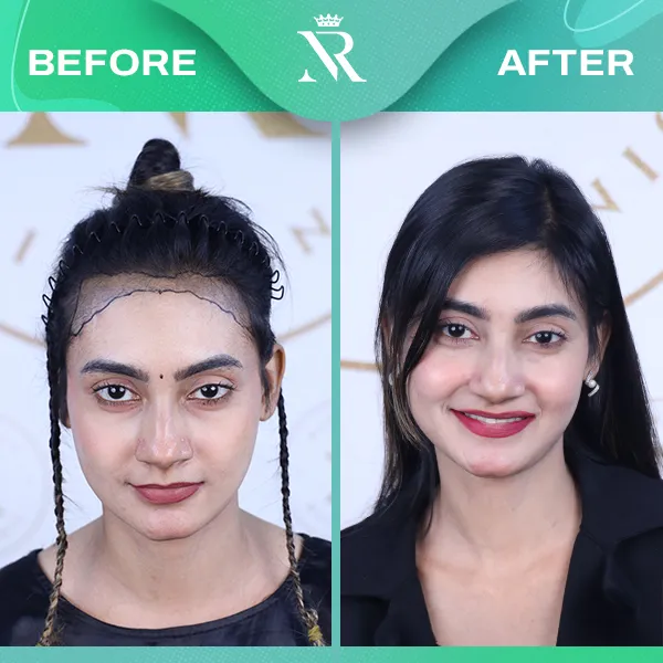 Celebrity Result 01 - Before & After