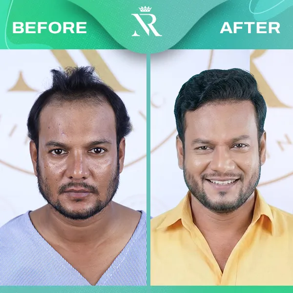Celebrity Result 03 - Before & After
