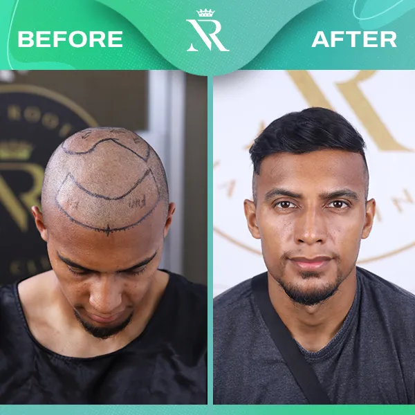 Celebrity Result 05 - Before & After
