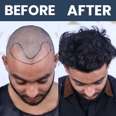 Hair Transplant