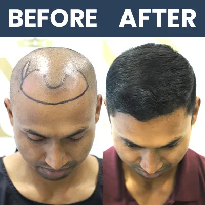 Hair Transplant
