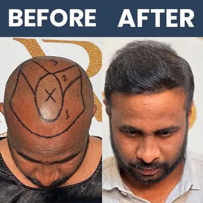 Hair Transplant