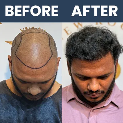 Hair Transplant