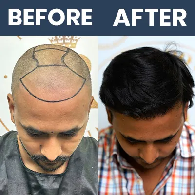 Hair Transplant