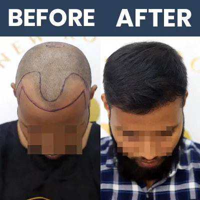 Hair Transplant