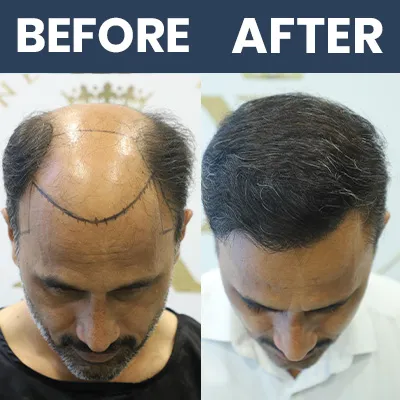 Hair Transplant