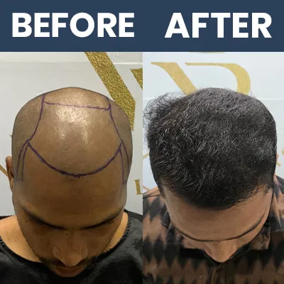 Hair Transplant